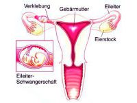 Eileiterschwangerschaft erkennen ssw